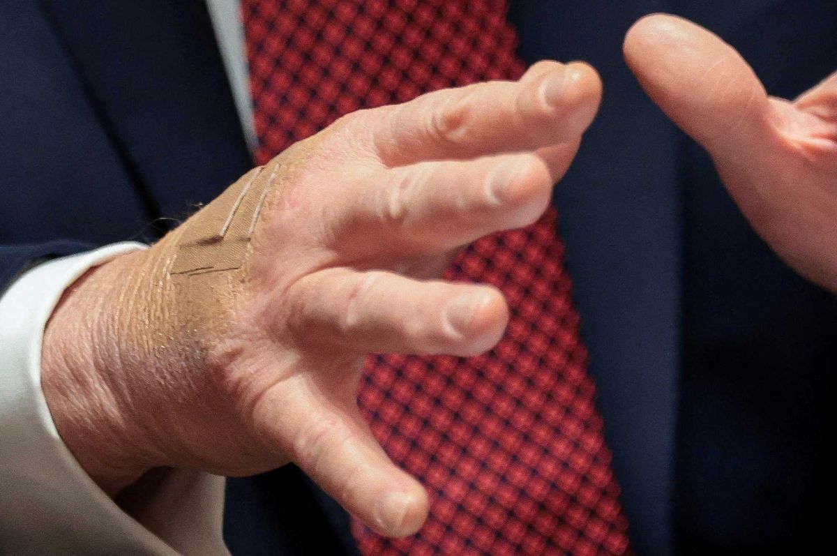 Critics doubt White House defense of Trump bandages: 'Is he shaking hands with chainsaws?'