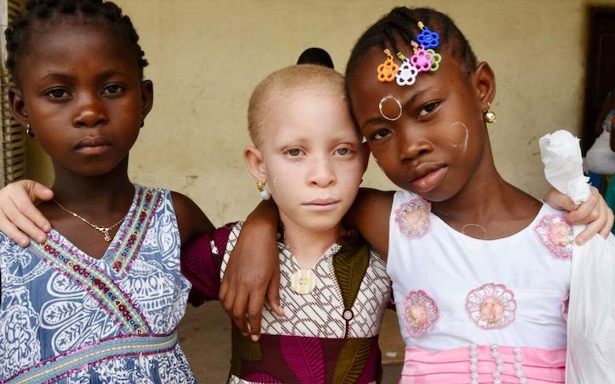 Albinism: lack of pigment plagued by deadly myths