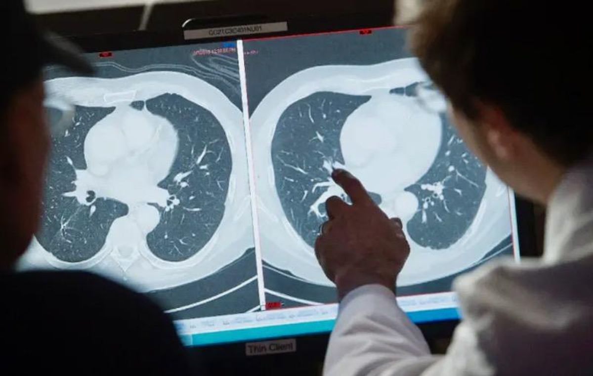 Higher cost of US cancer care doesn't improve survival rates: study