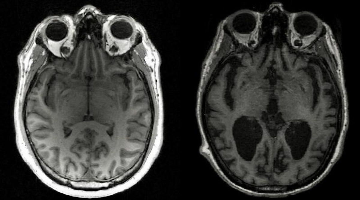 Scientists discover cause of Alzheimer's progression in brain