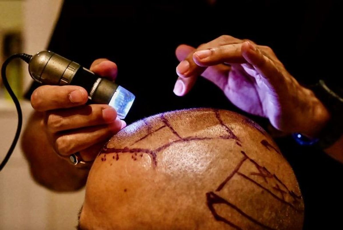 Hair transplant fad turns deadly in India