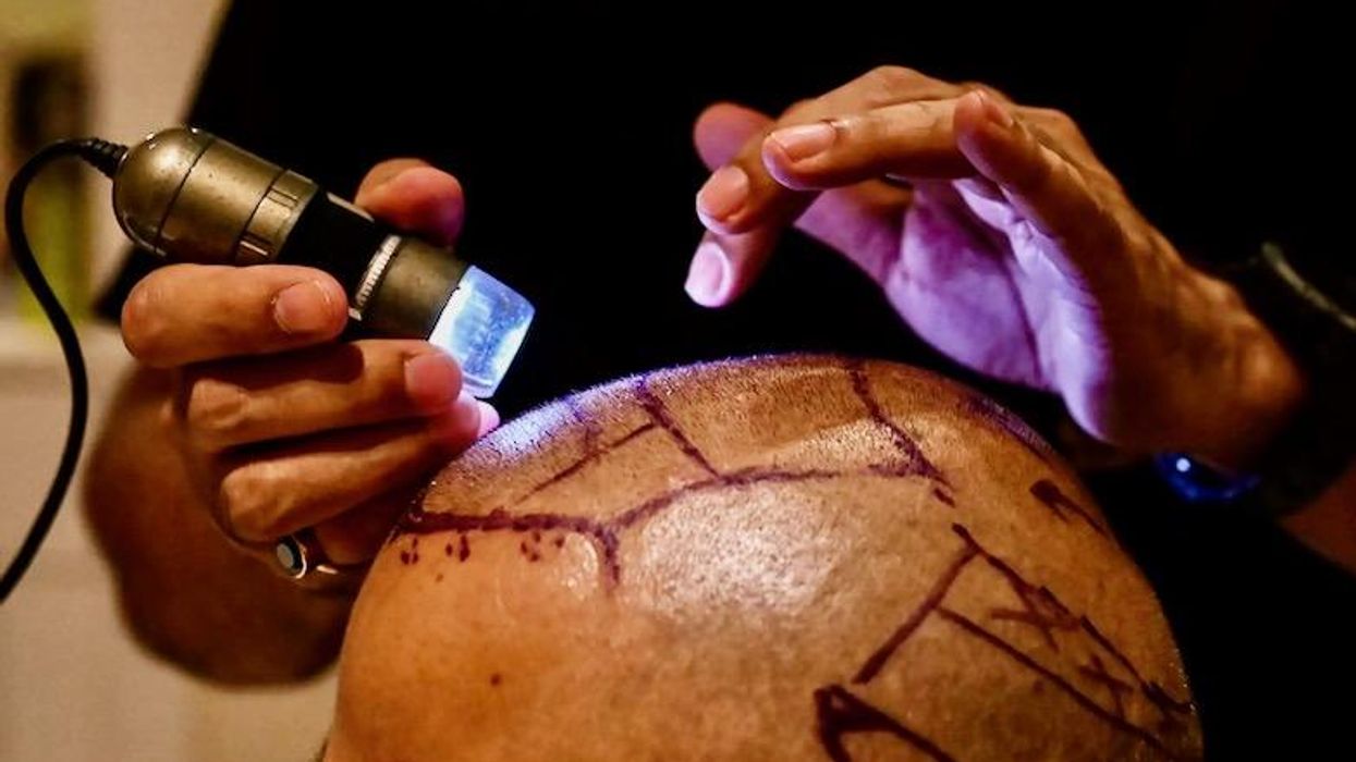 Hair transplant fad turns deadly in India