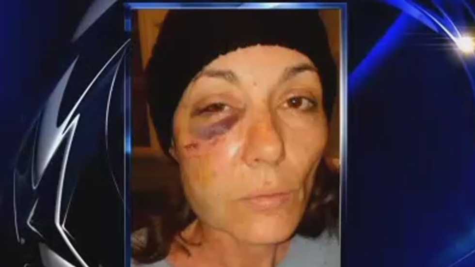 Illinois woman has reconstructive surgery after cop slams her face into concrete bench