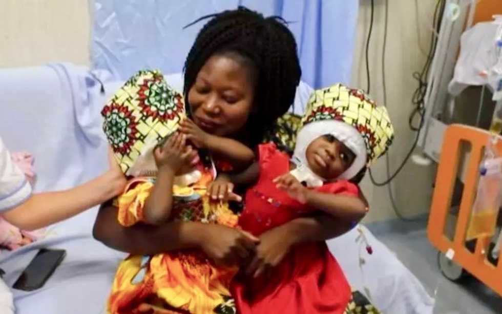 Two conjoined twins separated successfully in Italy