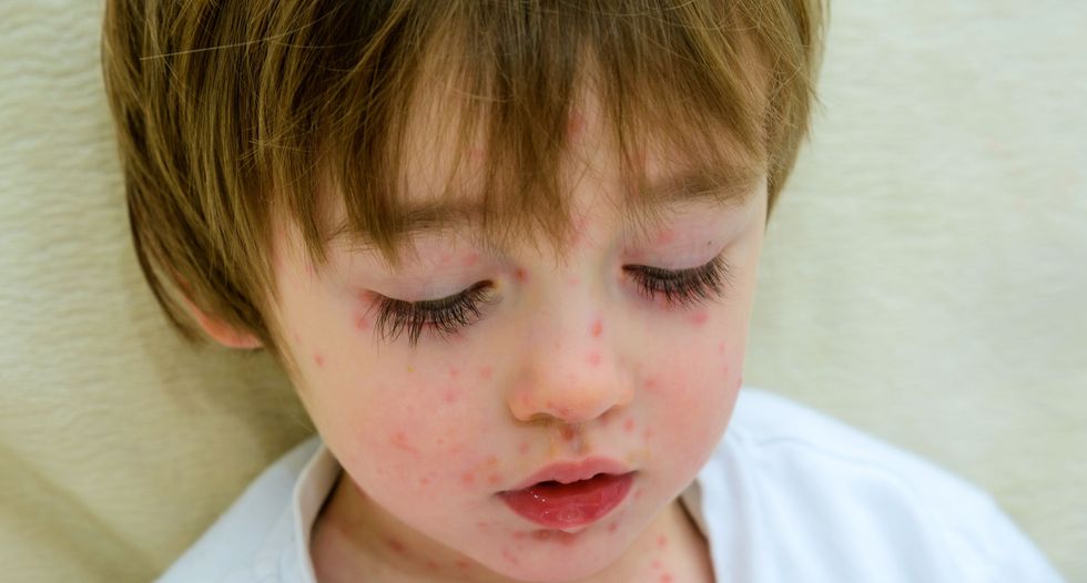Major chickenpox outbreak hits North Carolina town where many claim religious exemptions from vaccines
