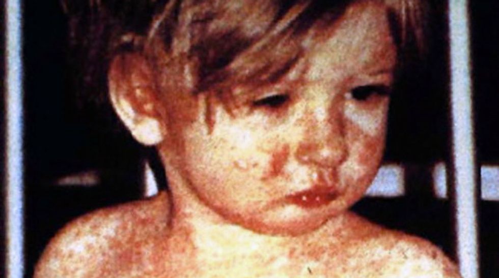 Anti-vaccine activists contributing to measles outbreaks around the U.S.