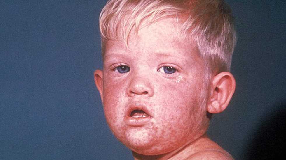 CDC blames science-denying anti-vaxxers for 20-year high in measles cases