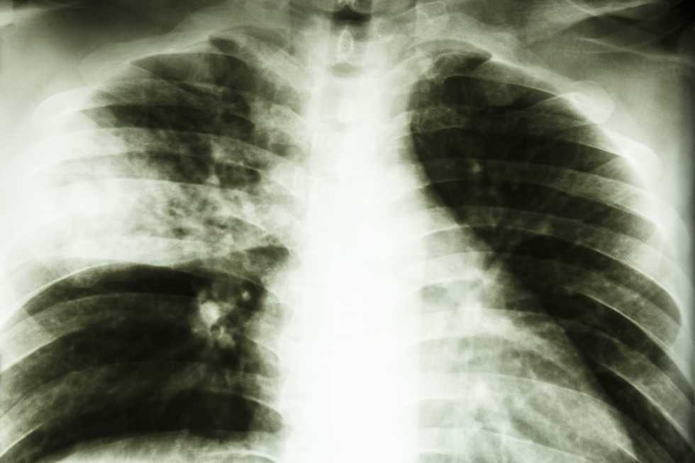 Tuberculosis kills thousands of people every day -- and we aren't doing enough to stop it