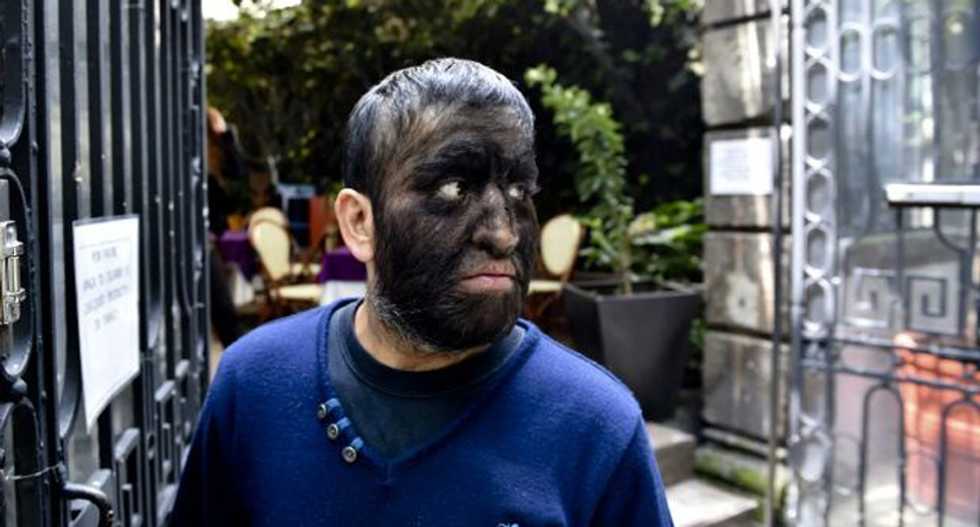 Mexican 'wolf man' battles isolation of rare condition