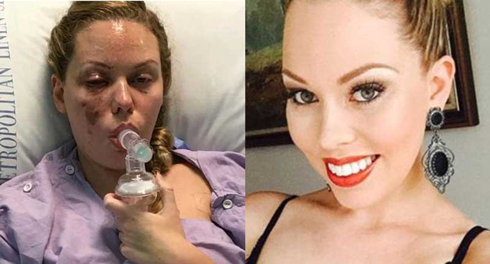 Miss Australia disfigured after cops threw a grenade into her bed while she was sleeping