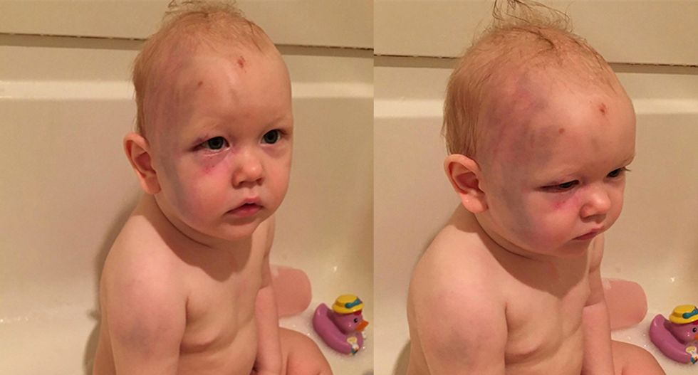 Anti-choice activists fight for abortion laws — but not for abused babies like this
