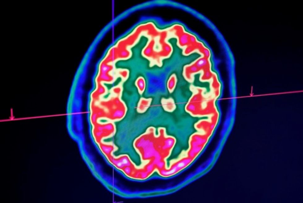 Confusion, seizure, strokes: How COVID-19 may affect the brain
