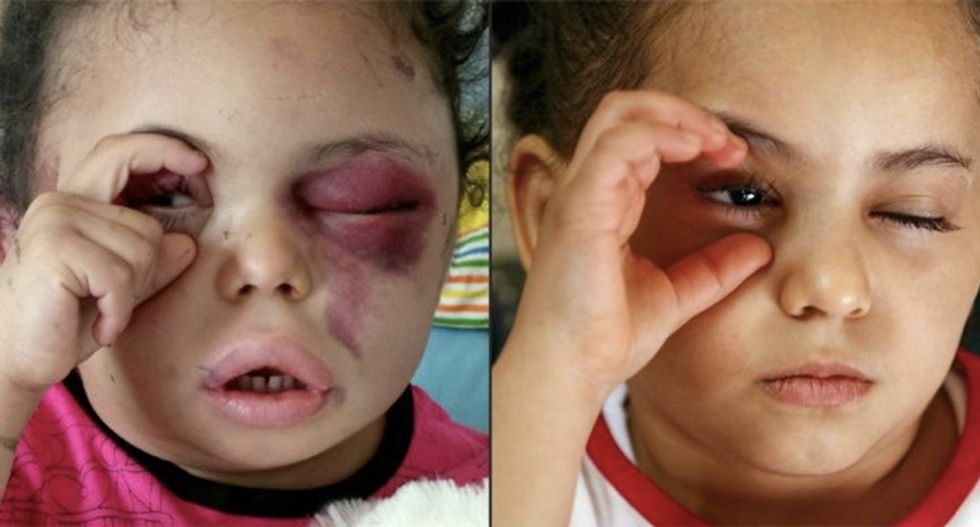 Young girl's heartbreaking story makes her symbol of Yemen war