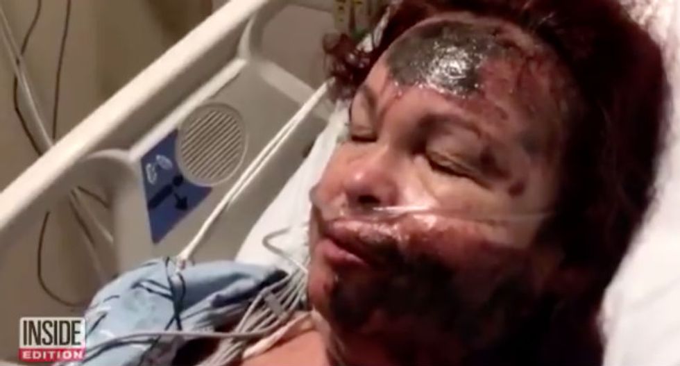 White woman sprays sulfuric acid into her own face — then blames it on a nonexistent black woman