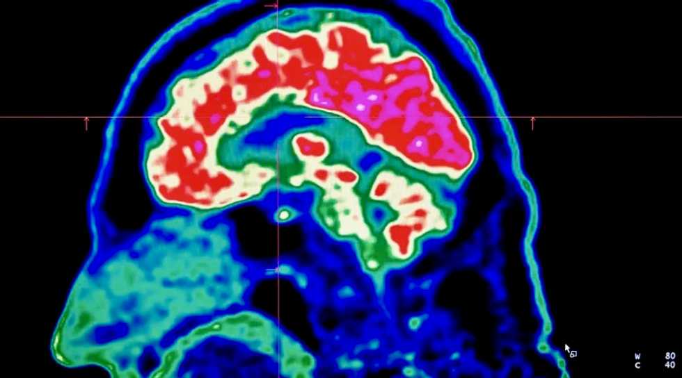 Brain problems linked to even mild virus infections: study