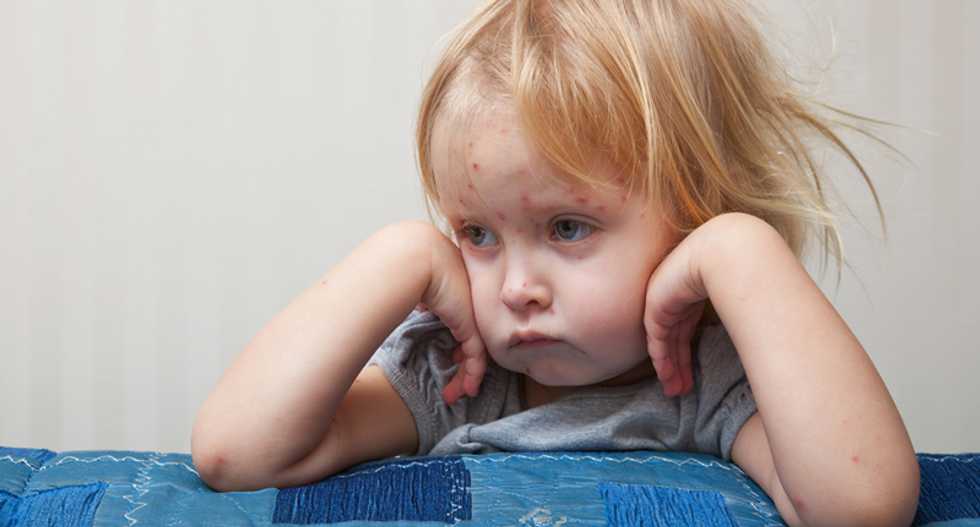California anti-vaxxers refuse to protect their kids from measles: 'What if they experience it. So what?'