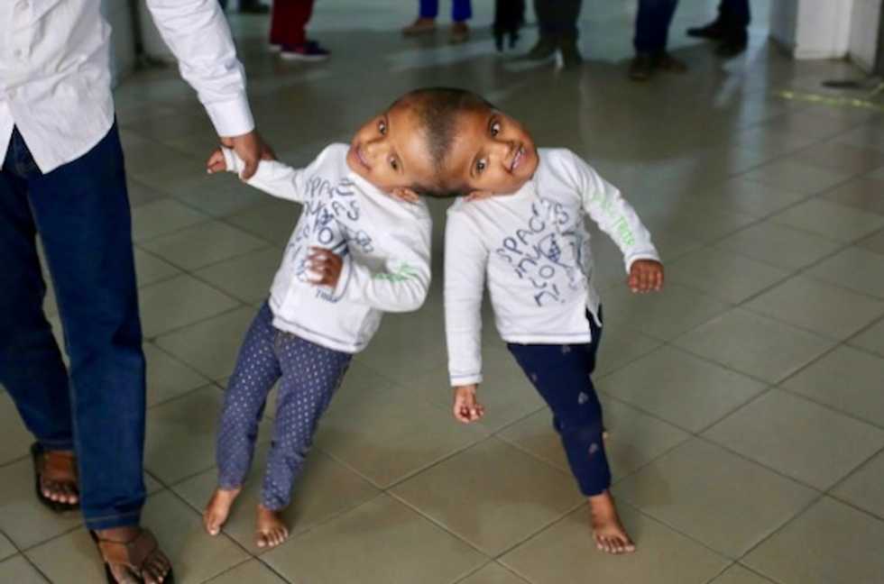 Hungarian doctors separate Bangladeshi twins joined at head