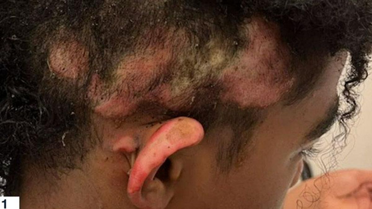 Teen was seriously injured after classmate set his hair on fire – but his school tried to 'brush it under the rug'