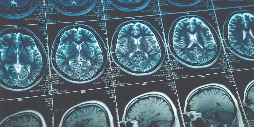 Even mild cases of COVID-19 might result in brain shrinkage and impaired cognitive function
