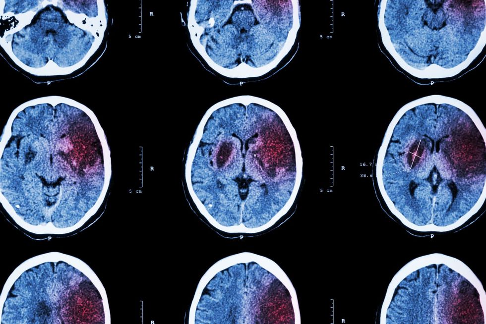 These 3 things this doctor learned from his stroke could save your life