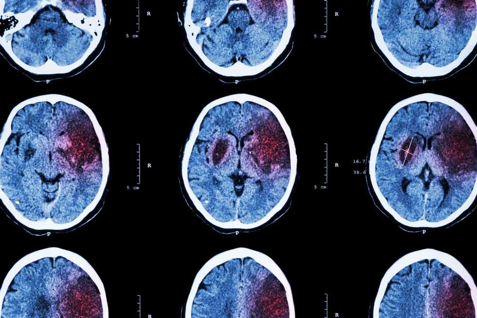These 3 things this doctor learned from his stroke could save your life
