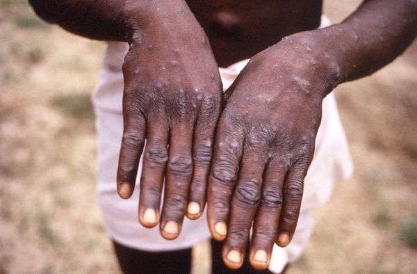 More than 700 monkeypox cases globally, 21 in US: CDC