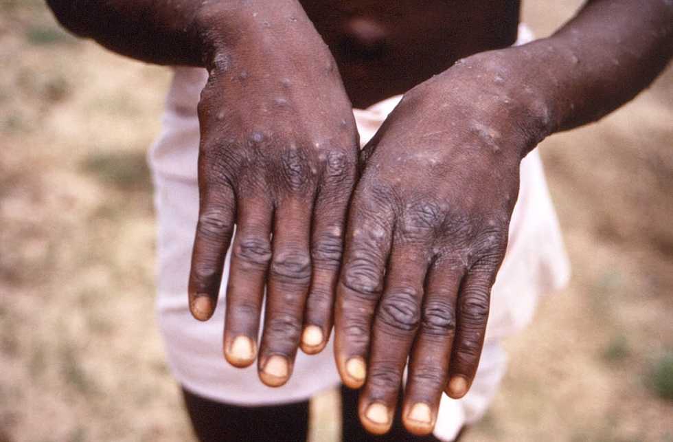 More than 700 monkeypox cases globally, 21 in US: CDC