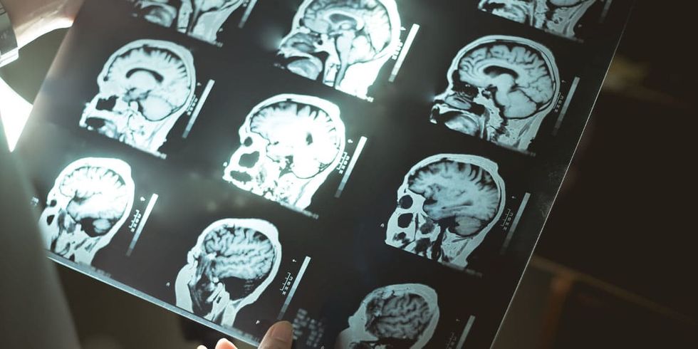 Neuroimaging study suggests serotonin reuptake inhibitor treatment can improve brain ventricle volume