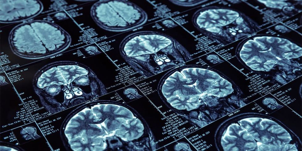 Depressed individuals have reduced connectivity in brain regions responsible for cognitive functioning