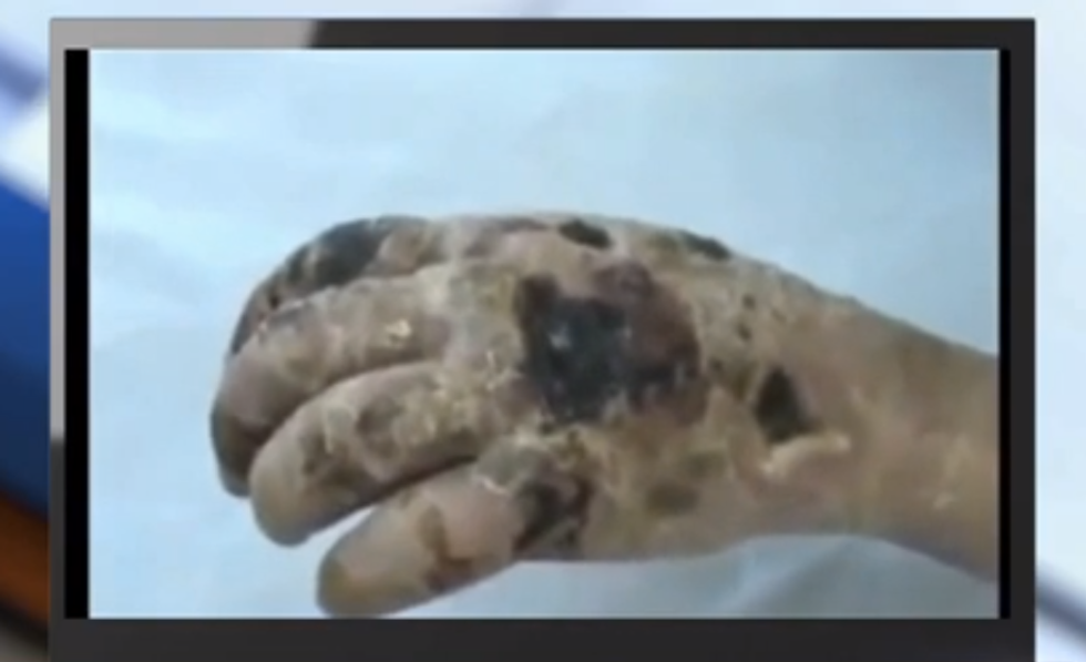 Doctors confirm: Use of flesh-eating opioid drug krokodil is spreading in U.S.