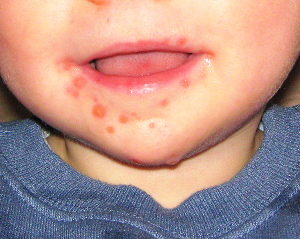 The return of hand, foot and mouth disease — and why children are the most susceptible