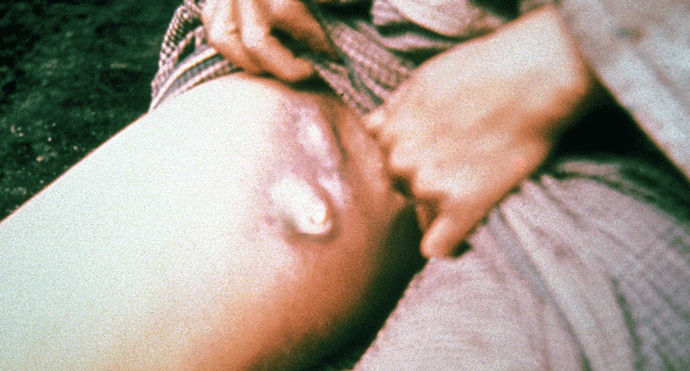 Teenage girl in Oregon hospitalized with bubonic plague