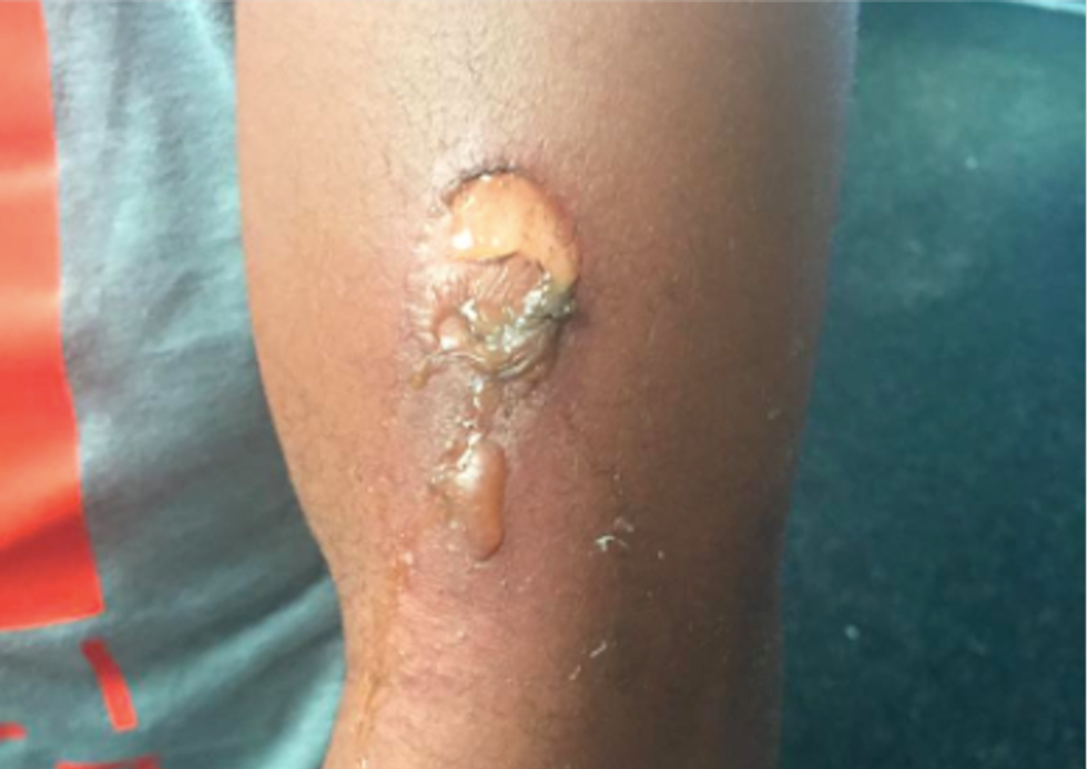 Black student burned with hot glue gun in Missouri high school's latest racist incident