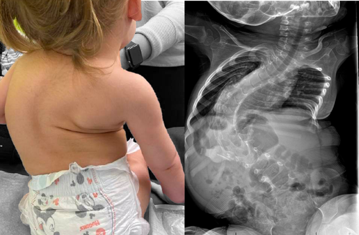 The ‘most expensive drug in the world’, how it works and the devastating disease it treats