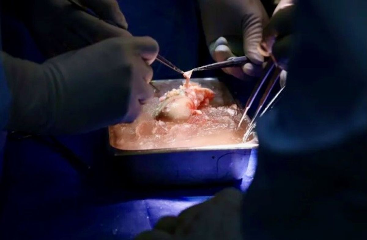 U.S. surgeons transplant pig kidney to live patient in world first