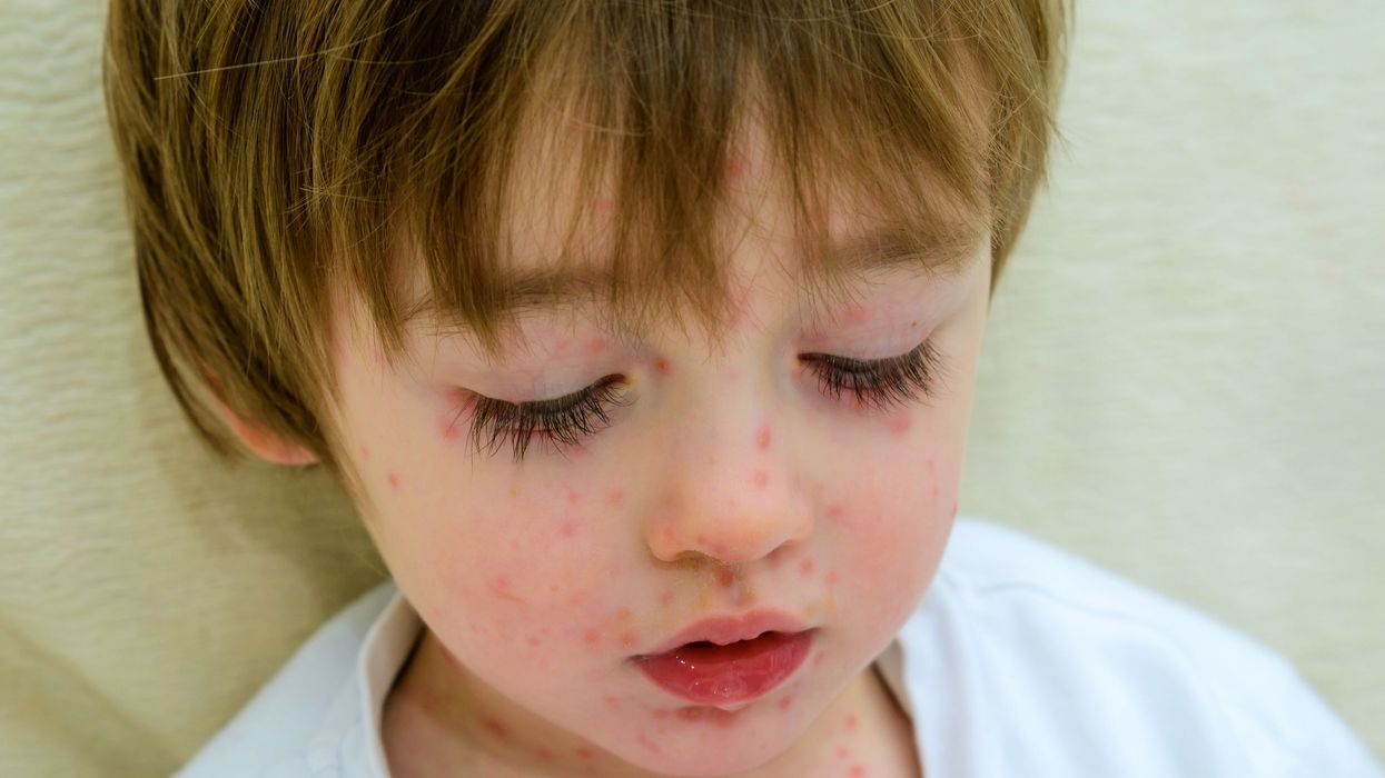 Chickenpox and shingles virus lying dormant in your neurons can reactivate and increase your risk of stroke – new research identified a potential culprit