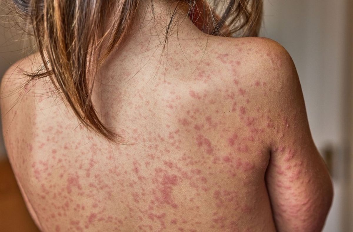 Red state makes skipping childhood vaccines easier after worst measles outbreak in decades