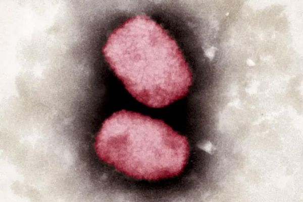 A California man’s 'painful and terrifying' road to a Monkeypox diagnosis