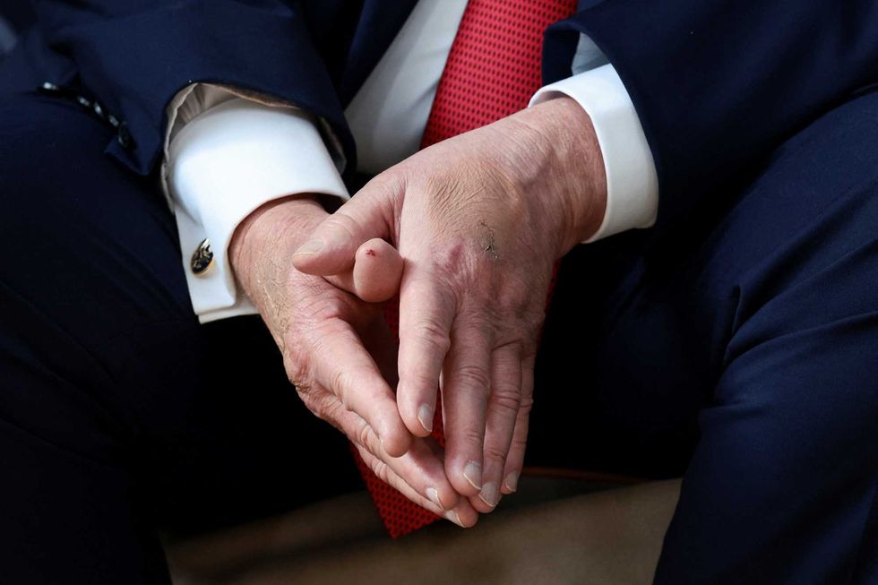 Trump sparks fresh health concerns after displaying new 'blotch' at G7 Summit: report