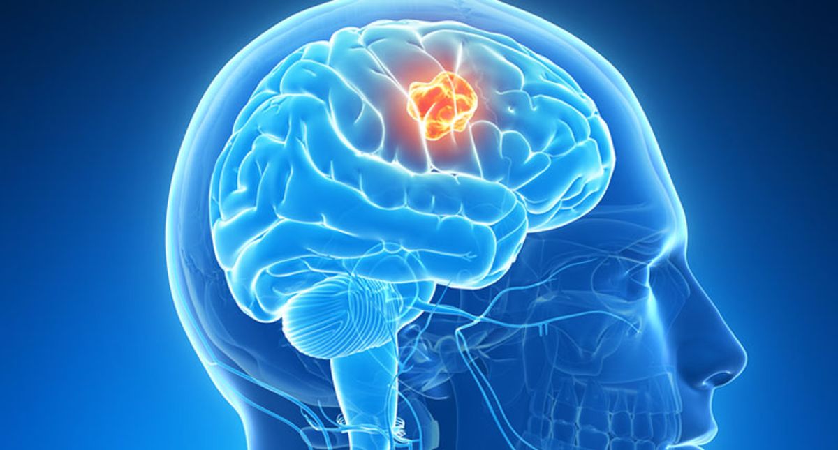 Brain tumors are cognitive parasites – how brain cancer hijacks neural circuits and causes cognitive decline